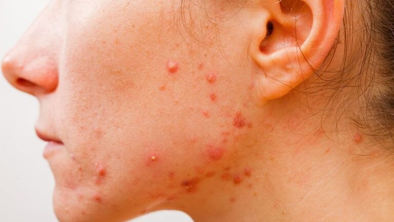 Understanding And Treating Different Types Of Acne